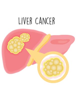 liver-cancer-treatment-in-gurgaon